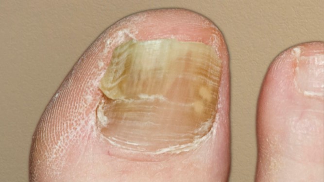 How to Treat a Nail Infection | HowStuffWorks