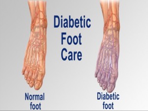 diabetic-foot