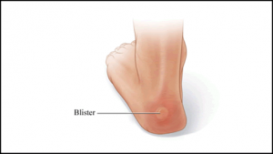 blister7