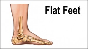 flat-feet5