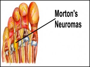 mortons-neuroma2